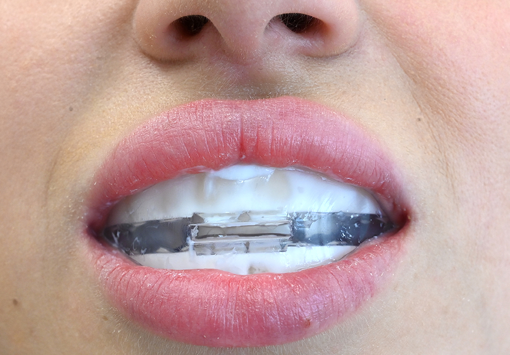 Remineralisation and MIH (chalk teeth) set